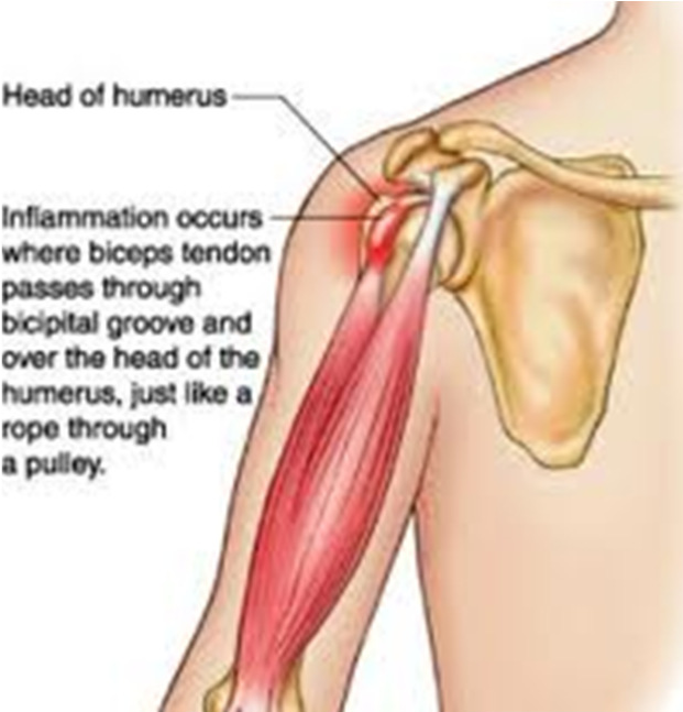 Biceps Tendinitis Brisbane Knee And Shoulder Clinic Dr