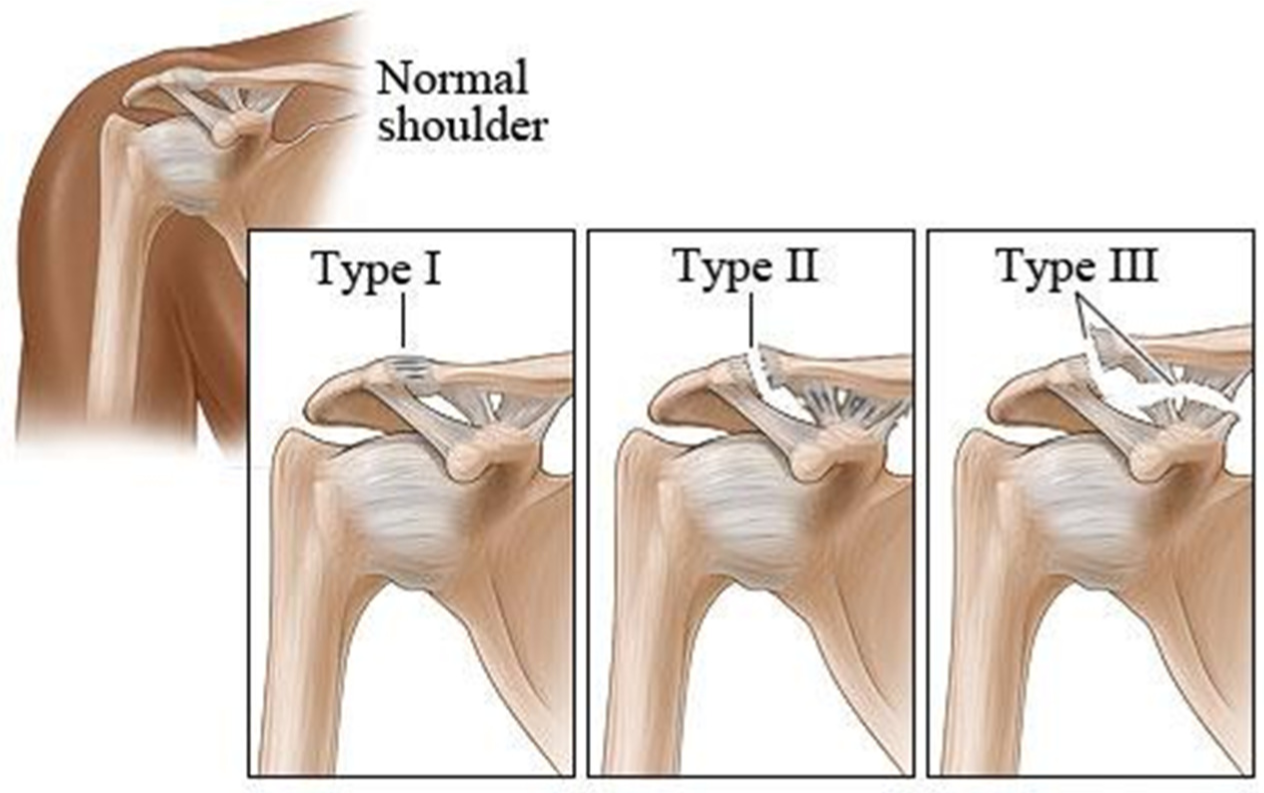 acromioclavicular joint separation treatment