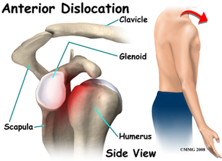 torn ligament in shoulder